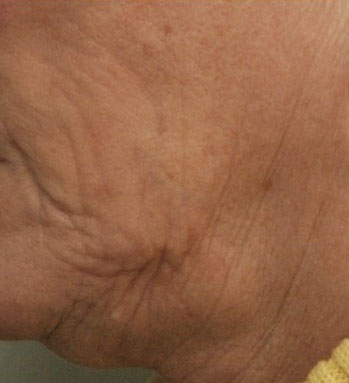 Wrinkles and laxity of the skin - Before
