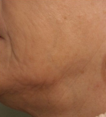Wrinkles and laxity of the skin - After