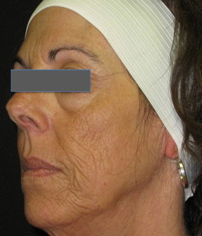 Wrinkles and laxity of the skin - Before