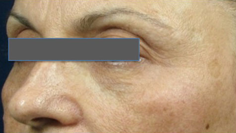 Wrinkles and laxity of the skin - After