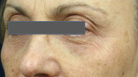 Wrinkles and laxity of the skin - Before