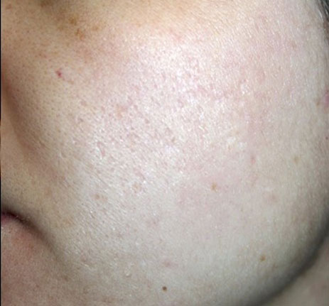 Acne Scarring - After