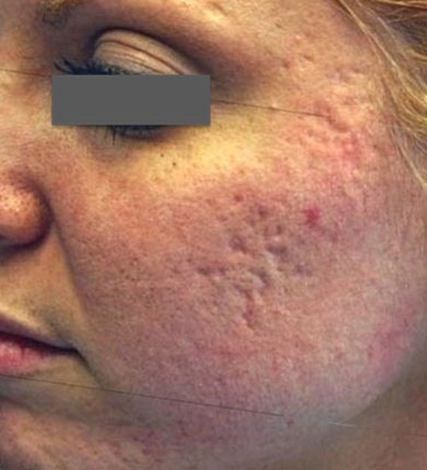 Acne Scarring - Before