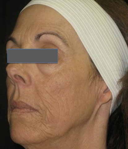 Wrinkles and laxity of the skin - After